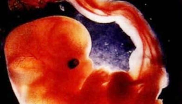 一个月胎囊图片图片