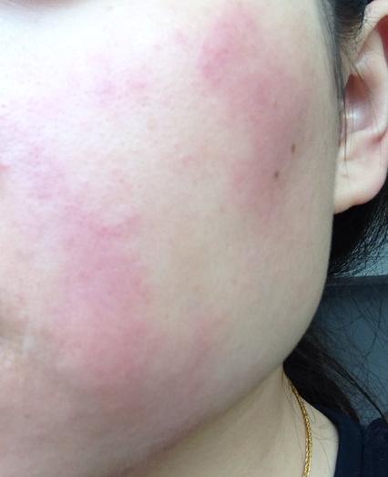 朵嘉浓玫玫;敏感肌肤发红发烫该怎么解决