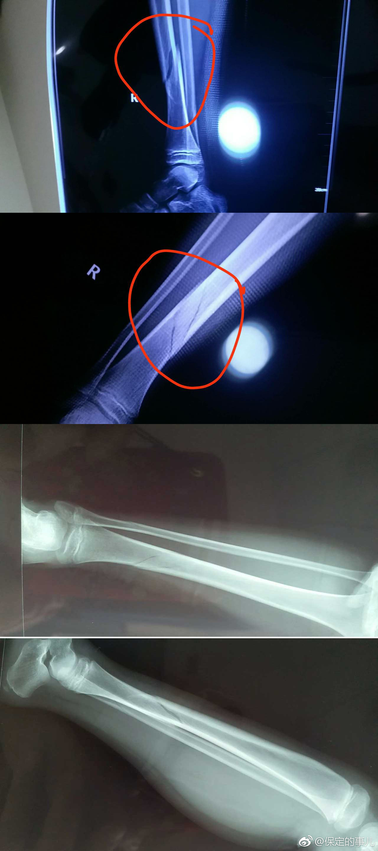 保定一小学生学校被高年级学生双杠拽下摔伤致骨折,校长竟然让家长