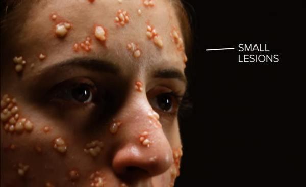 揭秘人类史上一项伟大发明:疫苗,多亏了这位疫苗之父|琴纳|牛痘|天花