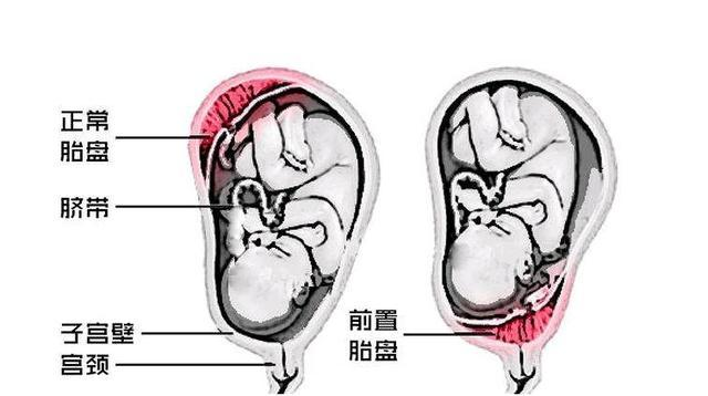 如果出现胎盘低置的问题一定注意左侧卧卧床休息,多吃高营养的食物