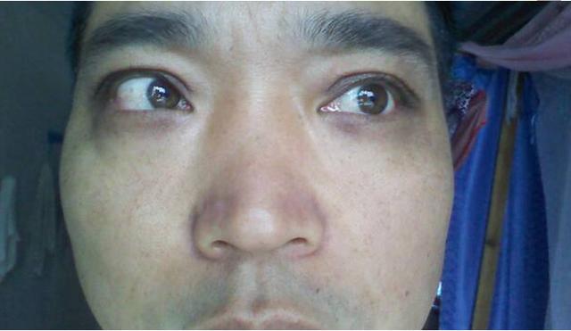 面容消瘦枯萎,脸颊有小血管扩张,口唇干燥,这就是"肝病面容"