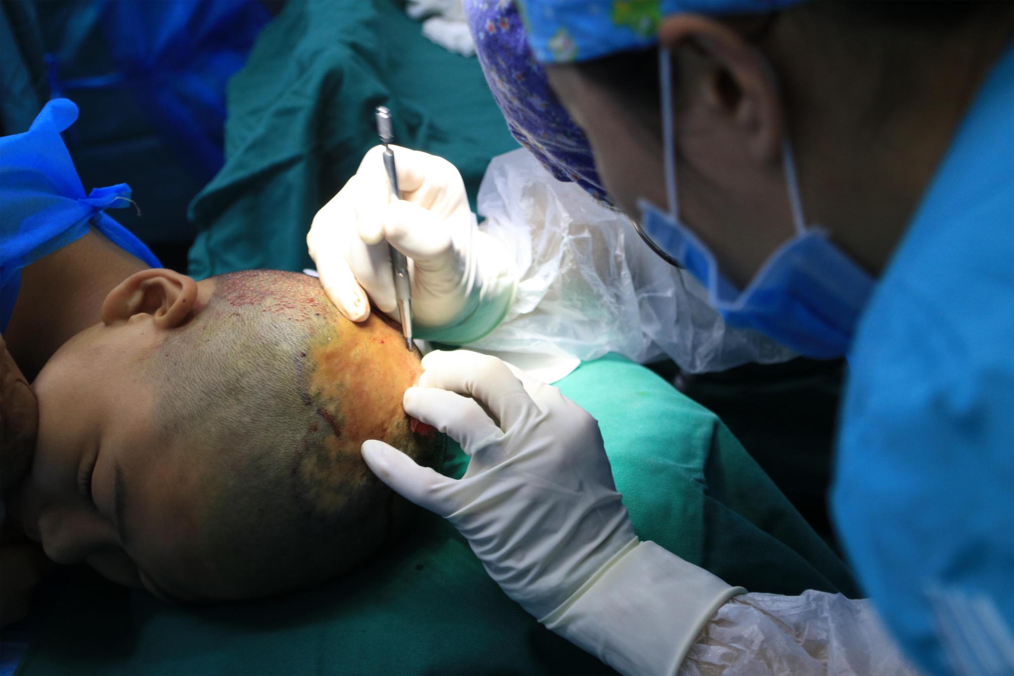 采用先进的青逸seh植发技术为小俊杰施行了*头发移植手术