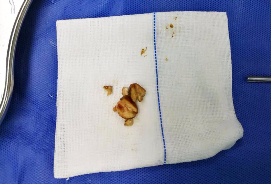 抵达医院时,患者出现呼吸急促,嘴唇发绀,明显四凹征等症状,情况危急