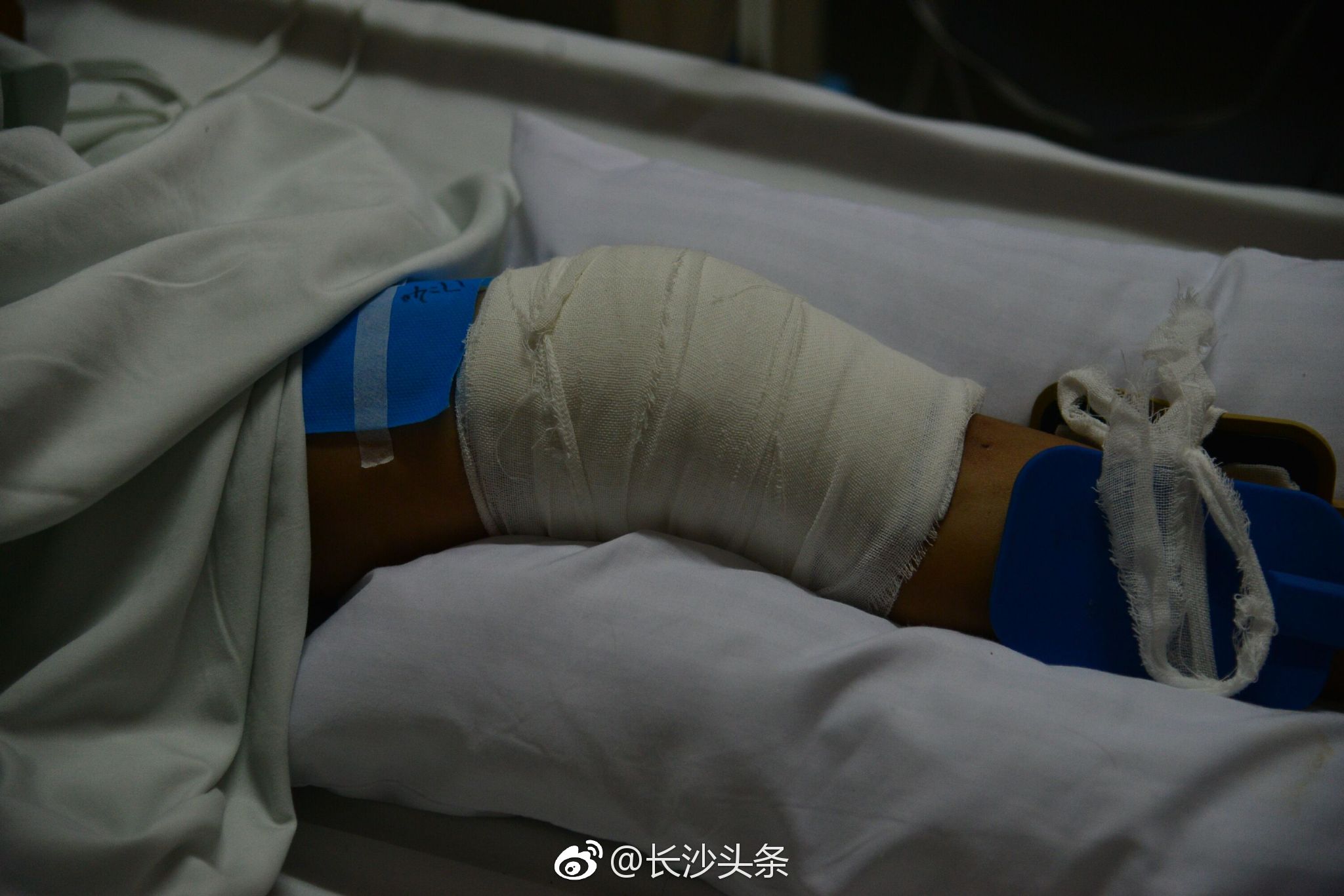 家中玻璃门突然炸裂 长沙7岁男童受伤入院