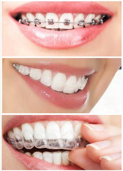 不就带个牙套嘛,为什么这么贵?