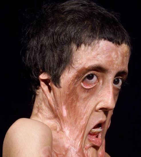 9岁小女孩被火烧得面目全非, 医生都要放弃她, 但她创造了奇迹