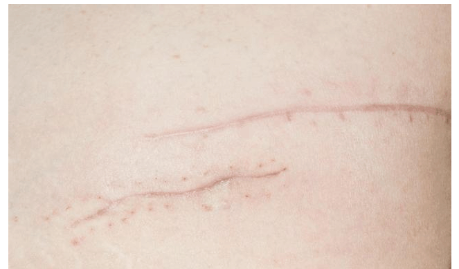 如果产程很顺利,撕裂的伤口也不大时,可以不侧切