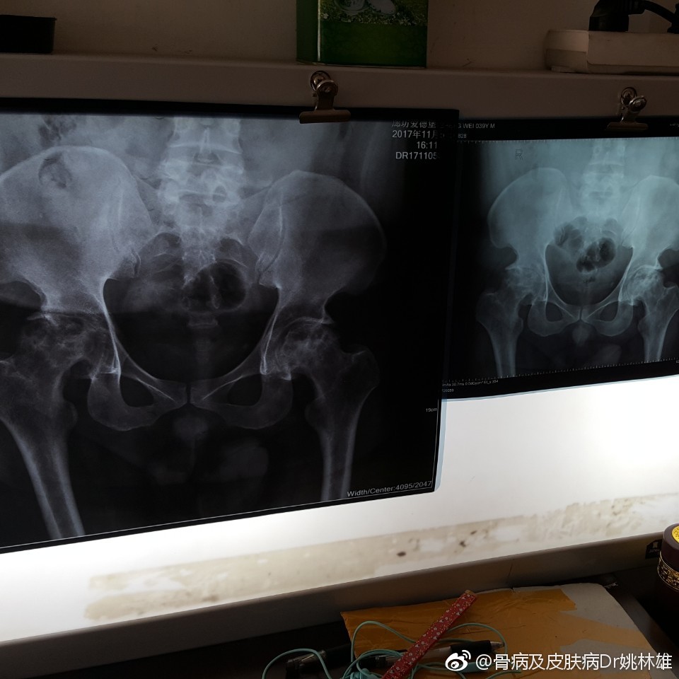 患者股骨头坏死三期,服用专治股骨头汤药,股骨头骨质增加