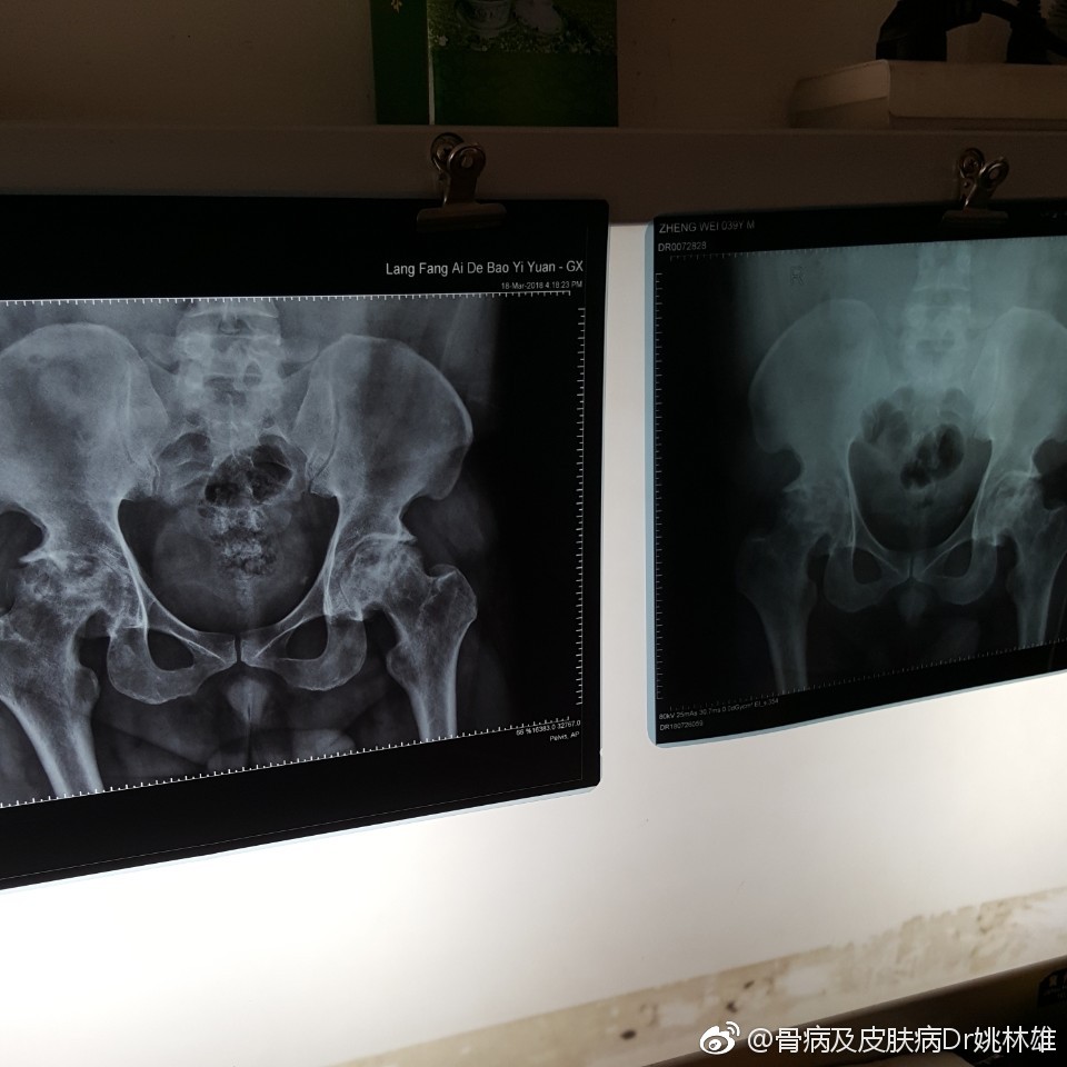 患者股骨头坏死三期,服用专治股骨头汤药,股骨头骨质增加