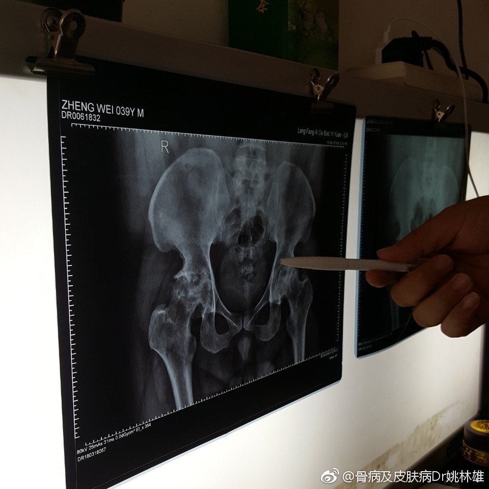 患者股骨头坏死三期,服用专治股骨头汤药,股骨头骨质增加