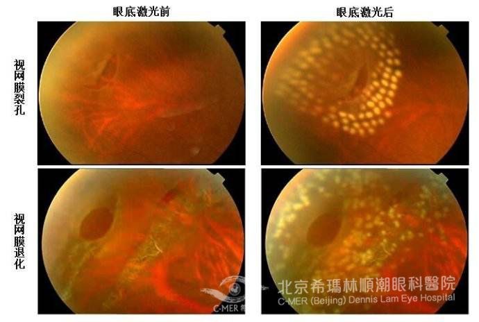 让人吓一跳的黄斑病变要怎么治疗