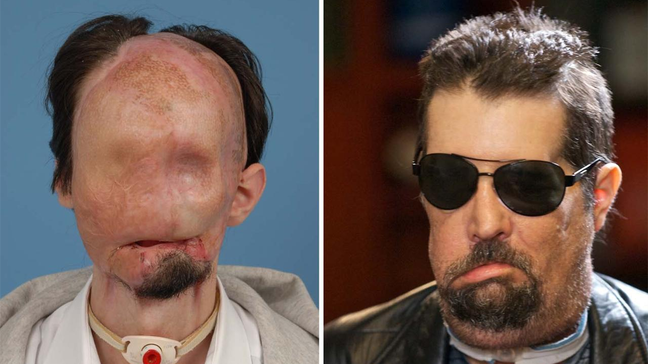 美国小伙意外毁容,政府花400万给他"换脸",术后效果惊人!