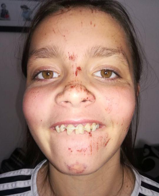 英国一名12岁的女孩,在车祸撞击中,牙齿裂开,自行车成两半