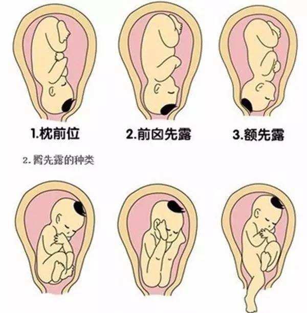 头位左枕横位胎儿图图片