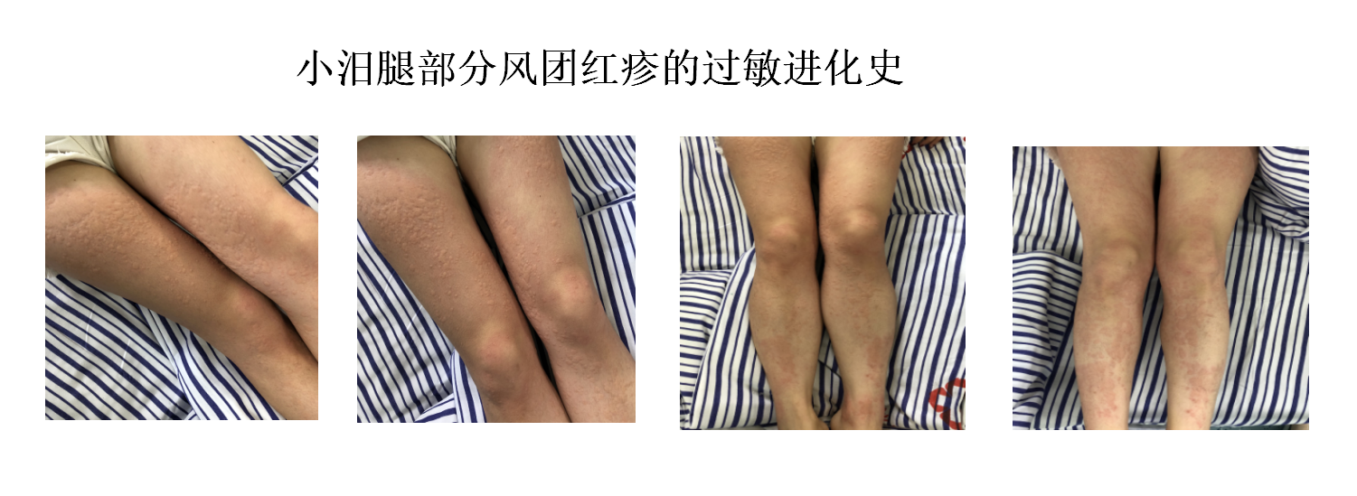 长沙一女子被昆虫蛰后,全身迅速长满风团