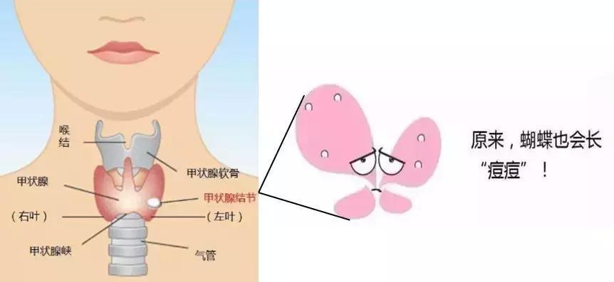 甲狀腺結節到底切不切?這個檢測告訴你答案!