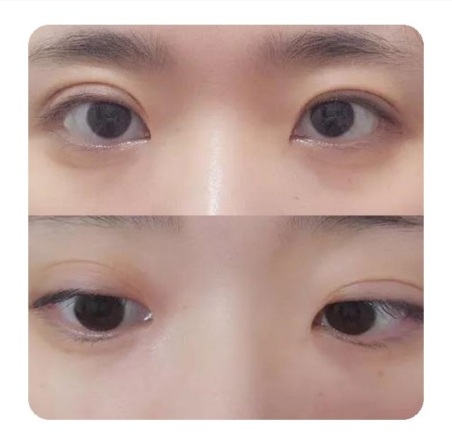 双眼皮不对称的原因及如何修复!割双眼皮术后必看