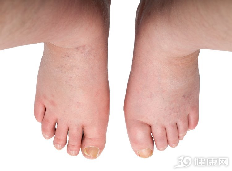 尿毒症的中晚期症状有哪些?