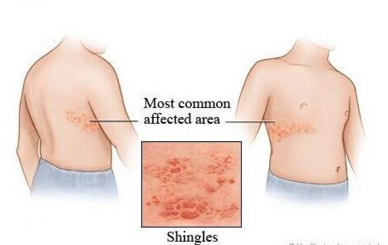 马思纯也中招,带状疱疹究竟有多厉害__财经头条