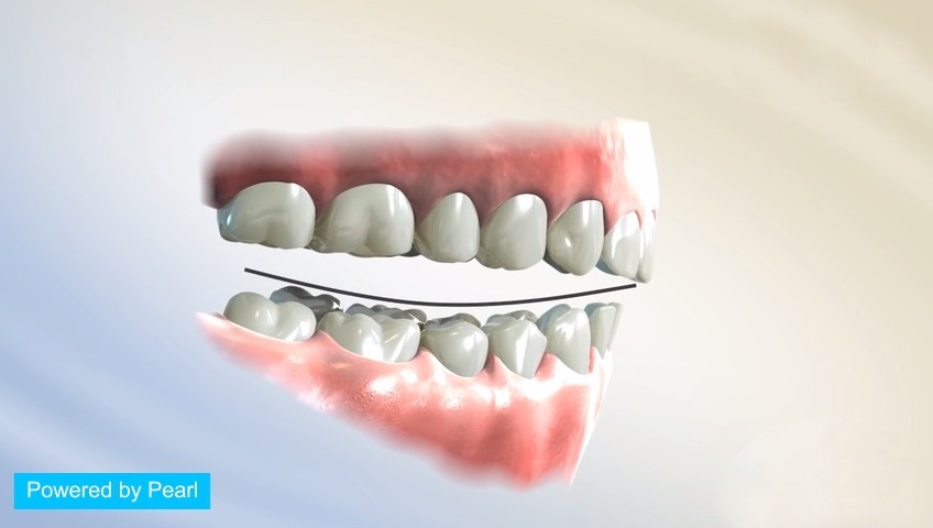 北京牙齿正畸 深覆合 牙齿深覆合矫正 牙齿矫正