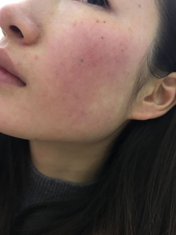 脸上泛红痘坑下面都是红红的毛孔粗大特别敏感怎么办