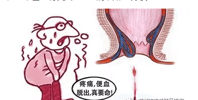 得了痔疮, 便秘,疼痛找上你, 那是因为你没学会这七招