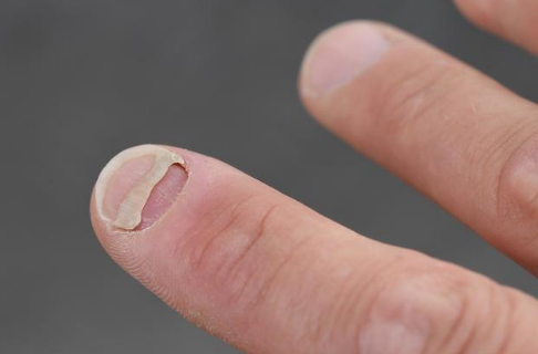 指甲容易分层怎么办了解3个治疗方法可选其一