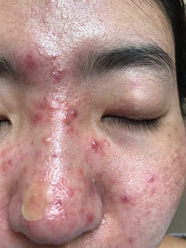 脸上反复起密密麻麻的小红疹子特别痒是不是激素脸