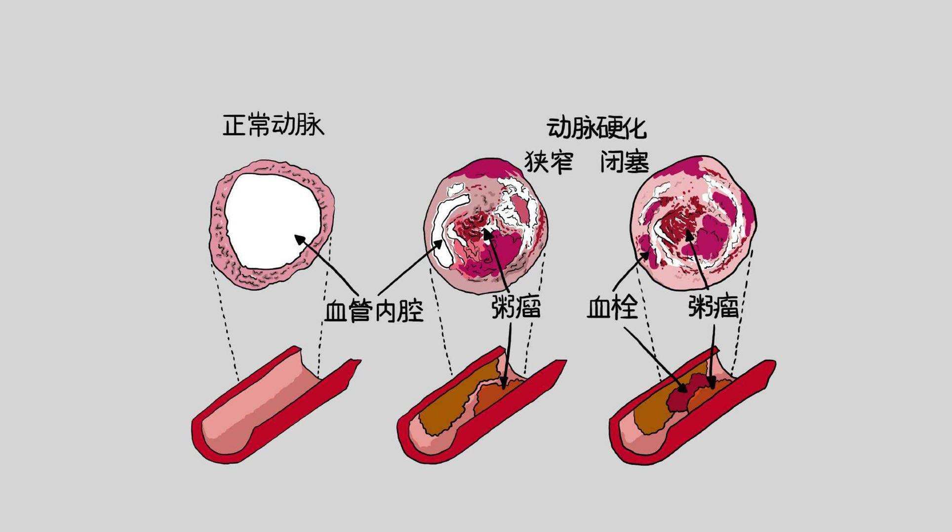 心血管堵了多少才算冠心病?