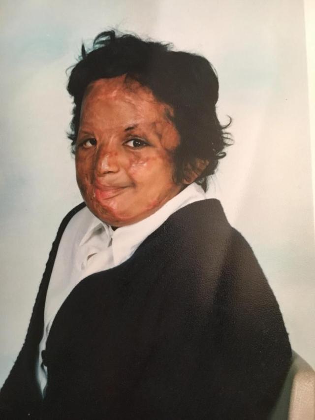 空难唯一幸存者,9岁女孩全身45%烧伤患抑郁症现在却.