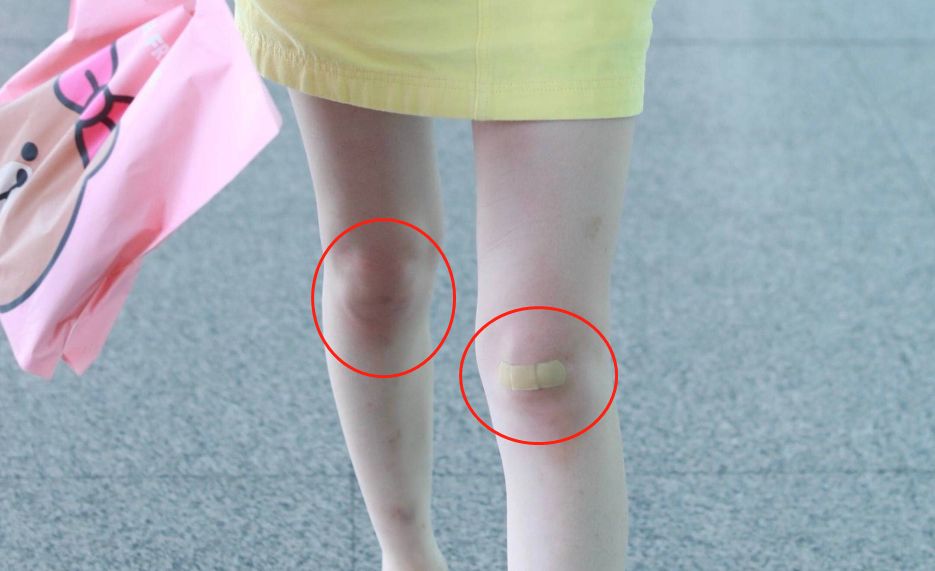 网友: 膝盖的伤是生日礼物吗