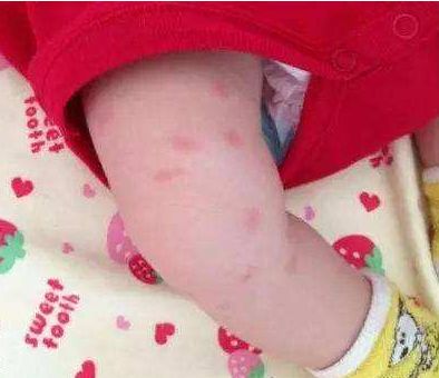 5个月的宝宝患皮肤病,罪魁祸首就是此物,很多宝妈都在用