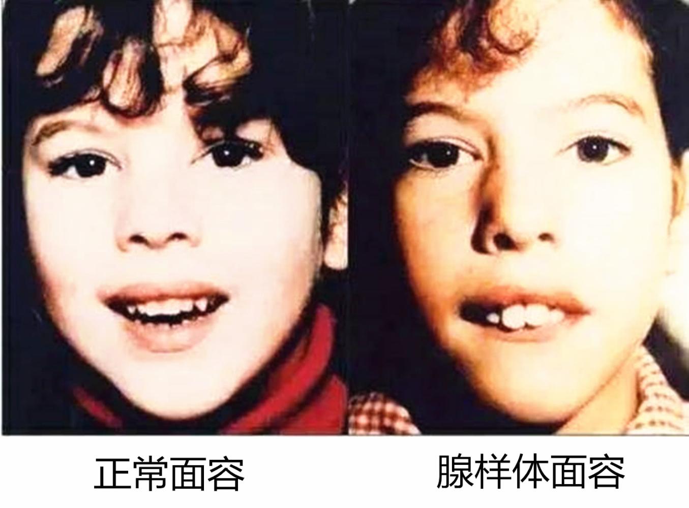 别让"腺样体面容"毁了孩子的颜值