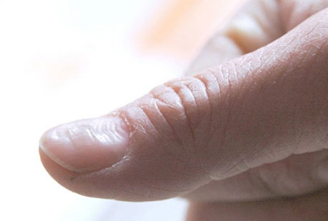 指甲有横纹是怎么回事横纹是缺乏营养吗