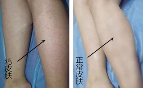 鸡皮肤穿裤子好吗(鸡皮肤穿裤子好吗图片) 鸡皮肤穿裤子好吗(鸡皮肤穿裤子好吗图片)