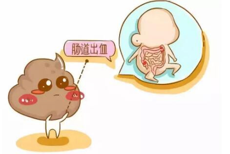 长沙医博解析: 什么是无痛性便血|直肠息肉|无痛性|内痔_新浪新闻