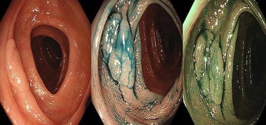大肠"闹情绪"会有5个警示,不想癌变,及早做肠镜!__财经头条