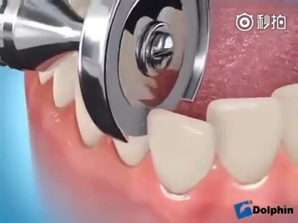 片切是在正畸治疗中很常见的获得间隙的方法所谓片切就是把牙齿的邻面