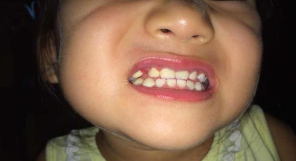 宝宝长成里扣齿上下门牙都往里内收源于妈妈做错这件事