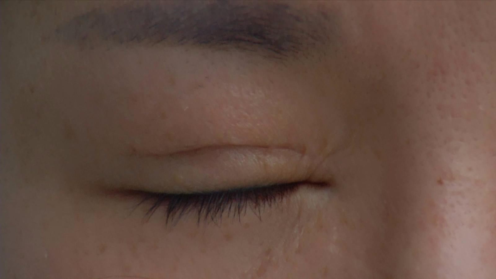 网上结识美容顾问,双眼皮手术留下明显疤痕,美容不成反而毁容!