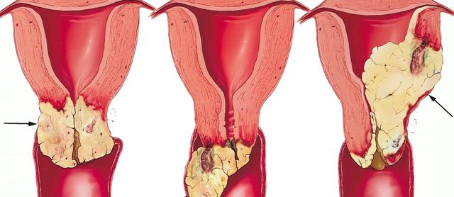 宫颈癌的早期症状图片图片