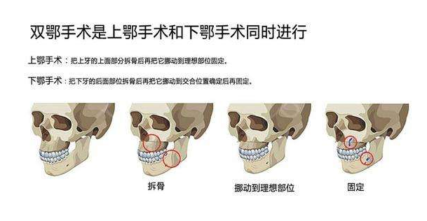 上颚:这个是拔牙的时候, 犬齿后的一个牙齿3.