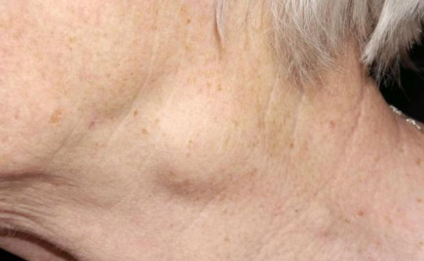 但是如果肿块不规则,边界不明,或是乳头溢液,乳房皮肤变成橘皮样,那么