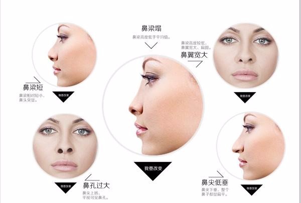 90后小姐姐的鞍鼻改造记(附图)