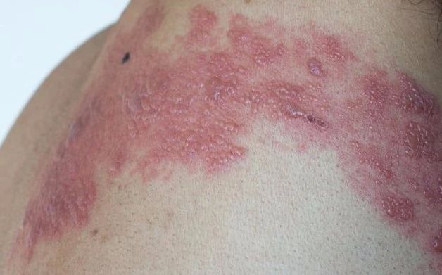 得过"缠腰火龙"的人,预防复发,一定做好这3件事!