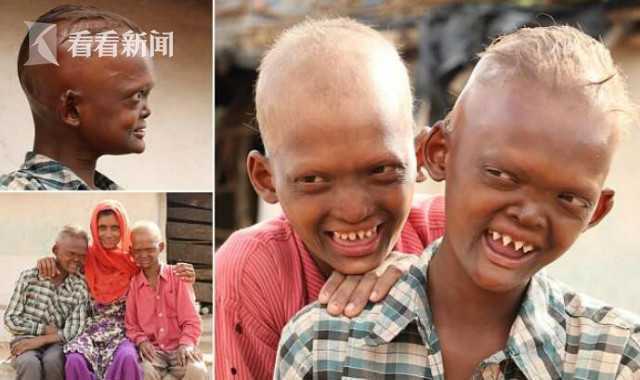 印度两兄弟长尖牙如外星人 头每半小时要浇次水[二哈][二哈][二哈]