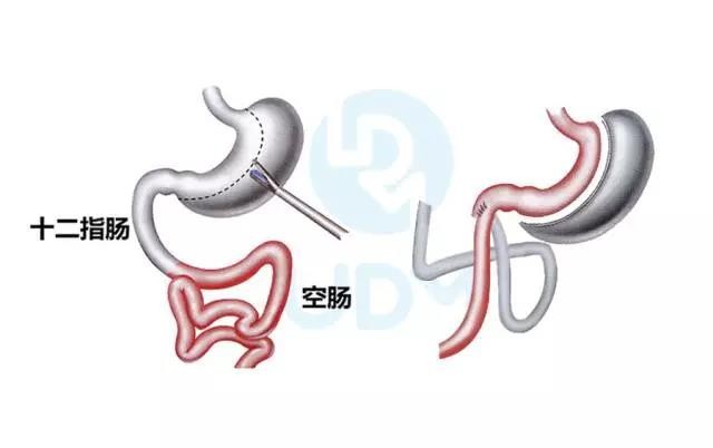 微创缩胃手术,减重效果怎么样?