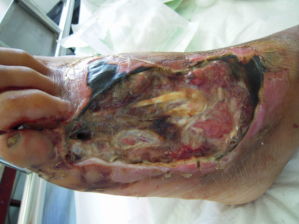 注意:这5个习惯让你得"糖尿病足"尤其是第三个,很多人都在犯