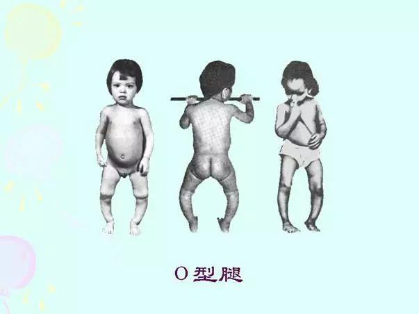 缺钙的宝宝会由于骨质软,表现为"x"形腿或者"o"形腿,肌肉松软无力